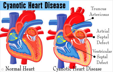 Cyanotic Heart Disease: Causes, Symptoms and Treatment Cyanotic Heart Disease: Causes, Symptoms and Treatment