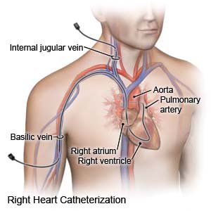 Right Heart Catheterization Explained: Procedure, Uses And Risks
